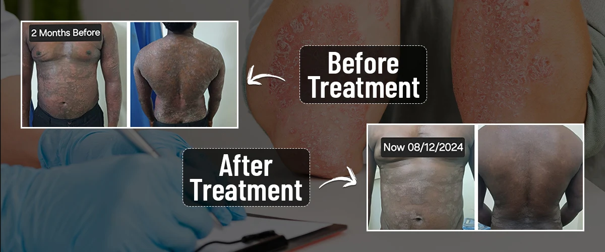 Complete Relief From Chronic Severe Psoriasis through Drs Siddha